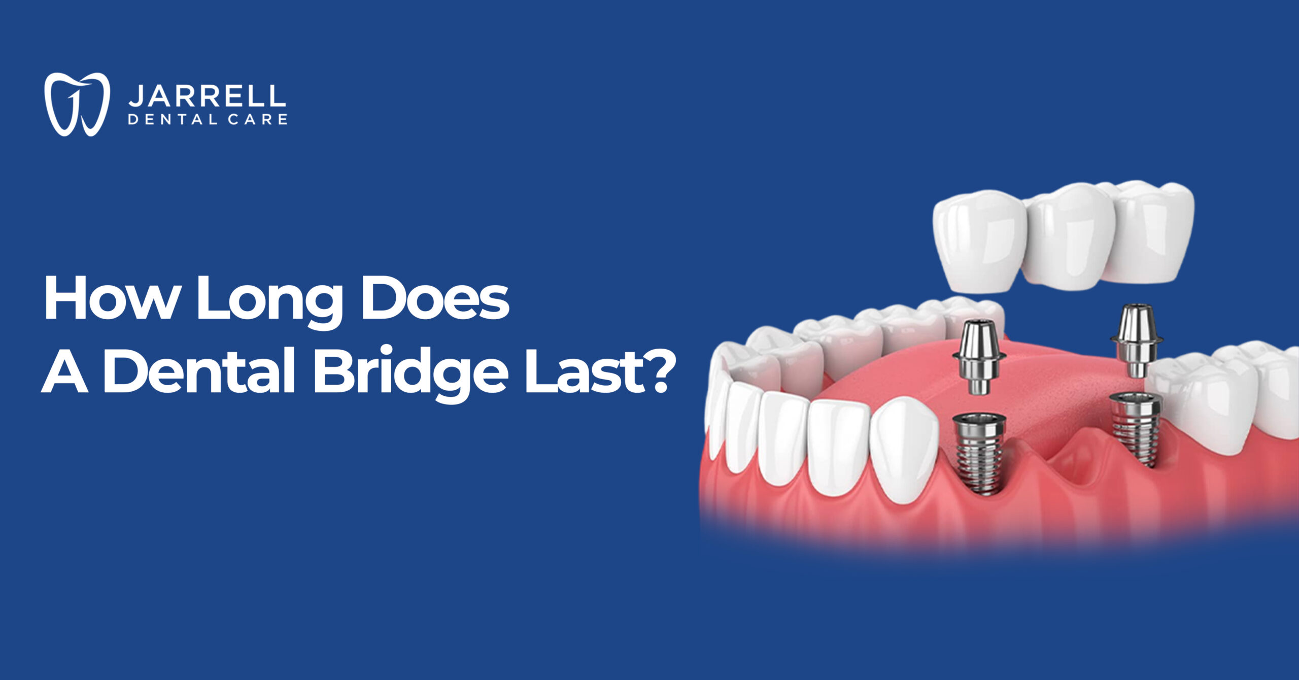 How Long Does a Dental Bridge Last?
