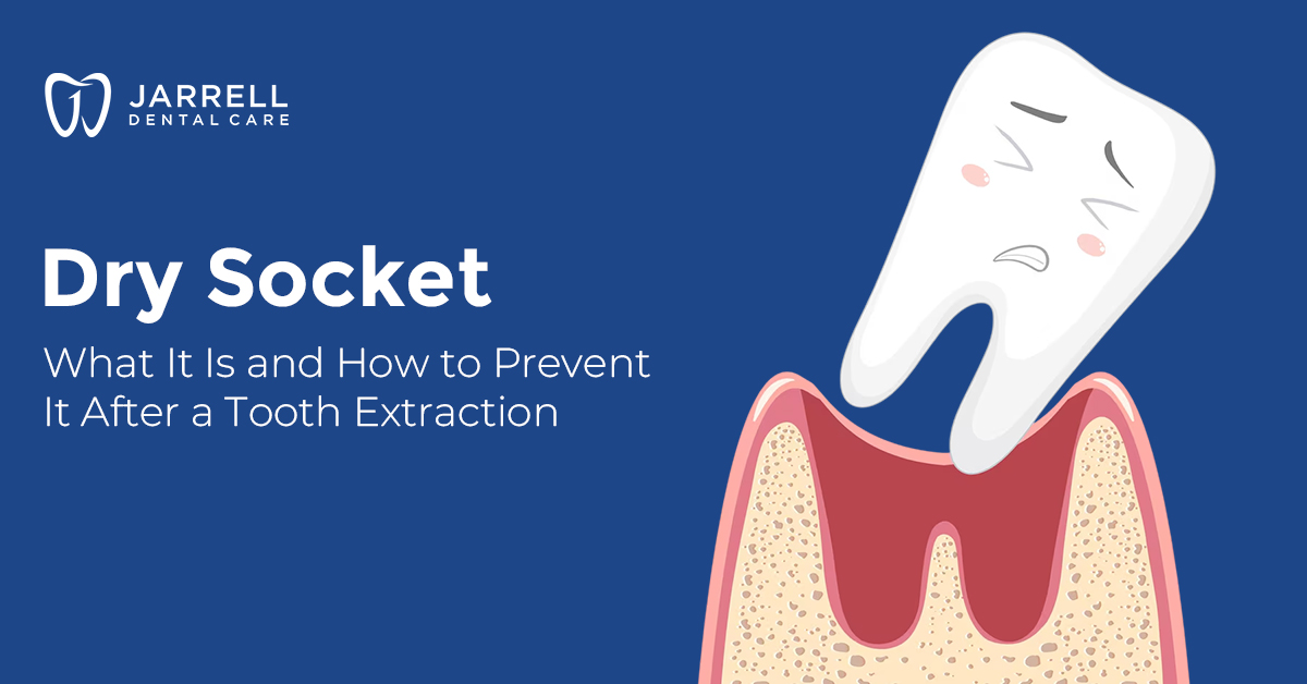 Dry Socket: What It Is and How to Prevent It After a Tooth Extraction