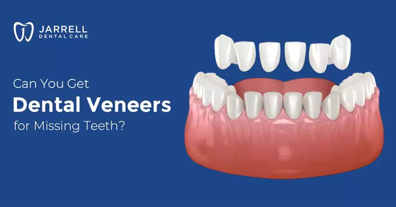Can You Get Dental Veneers for Missing Teeth?