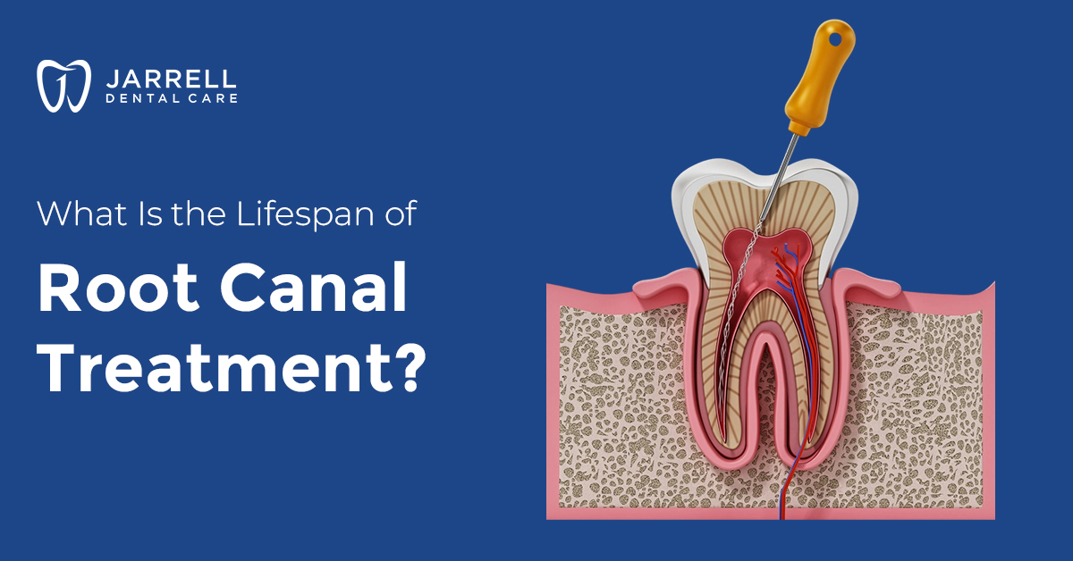 What Is The Lifespan of Root Canal Treatment?