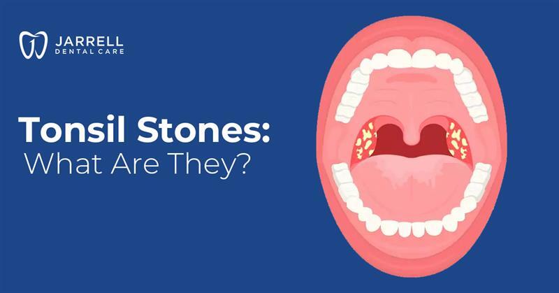 Tonsil Stones: What Are They?
