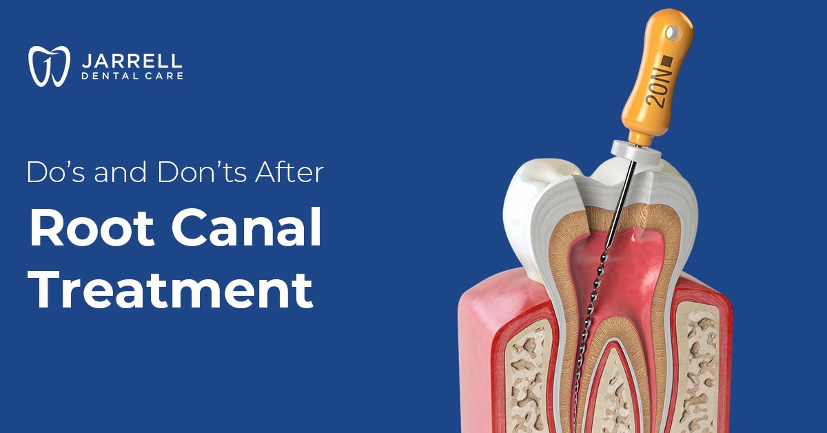 Do’s and Don’ts After Root Canal Treatment
