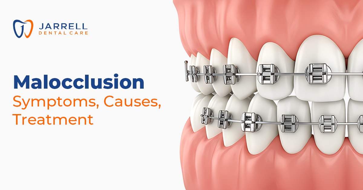 Malocclusion – Symptoms, Causes, and Treatment