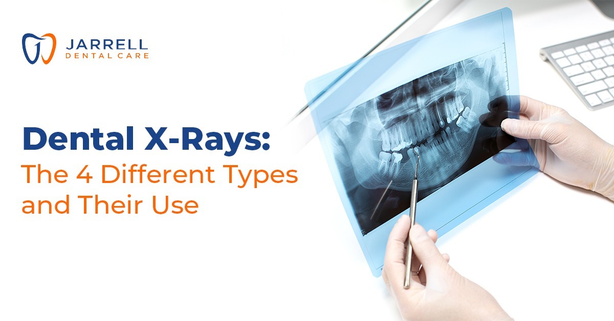Dental X-Rays: The 4 Different Types and Their Use