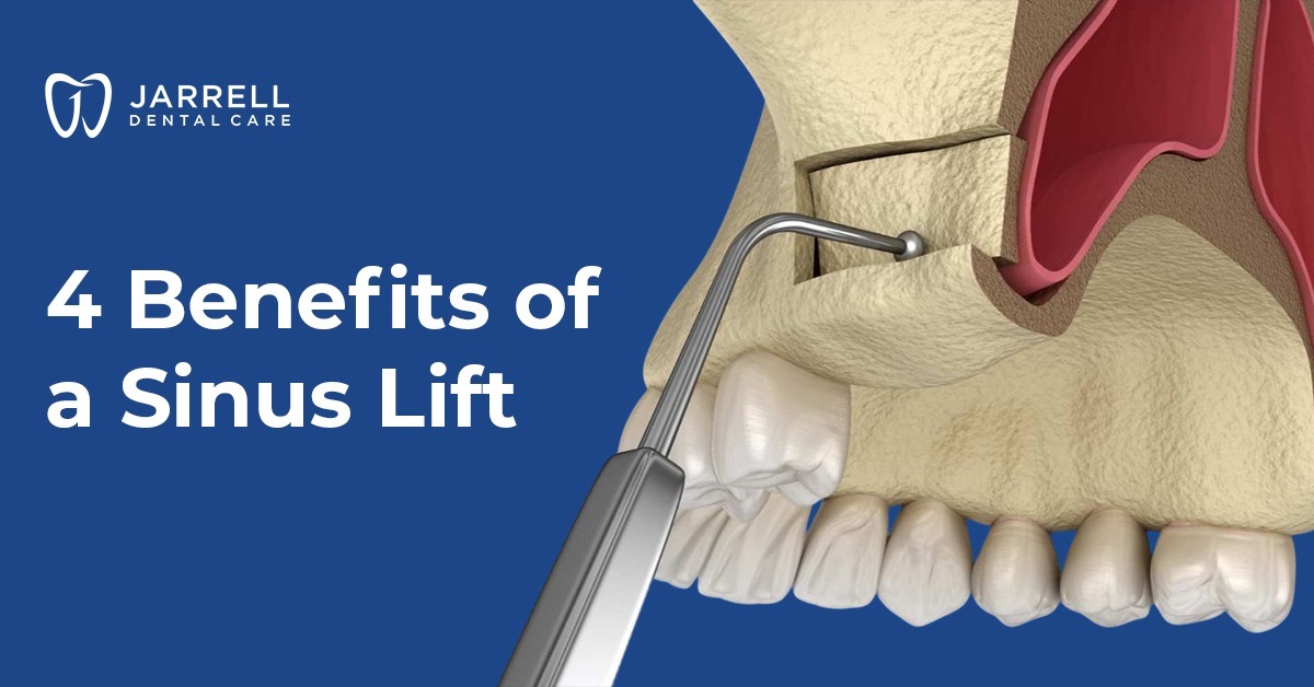 4 Benefits of a Sinus Lift