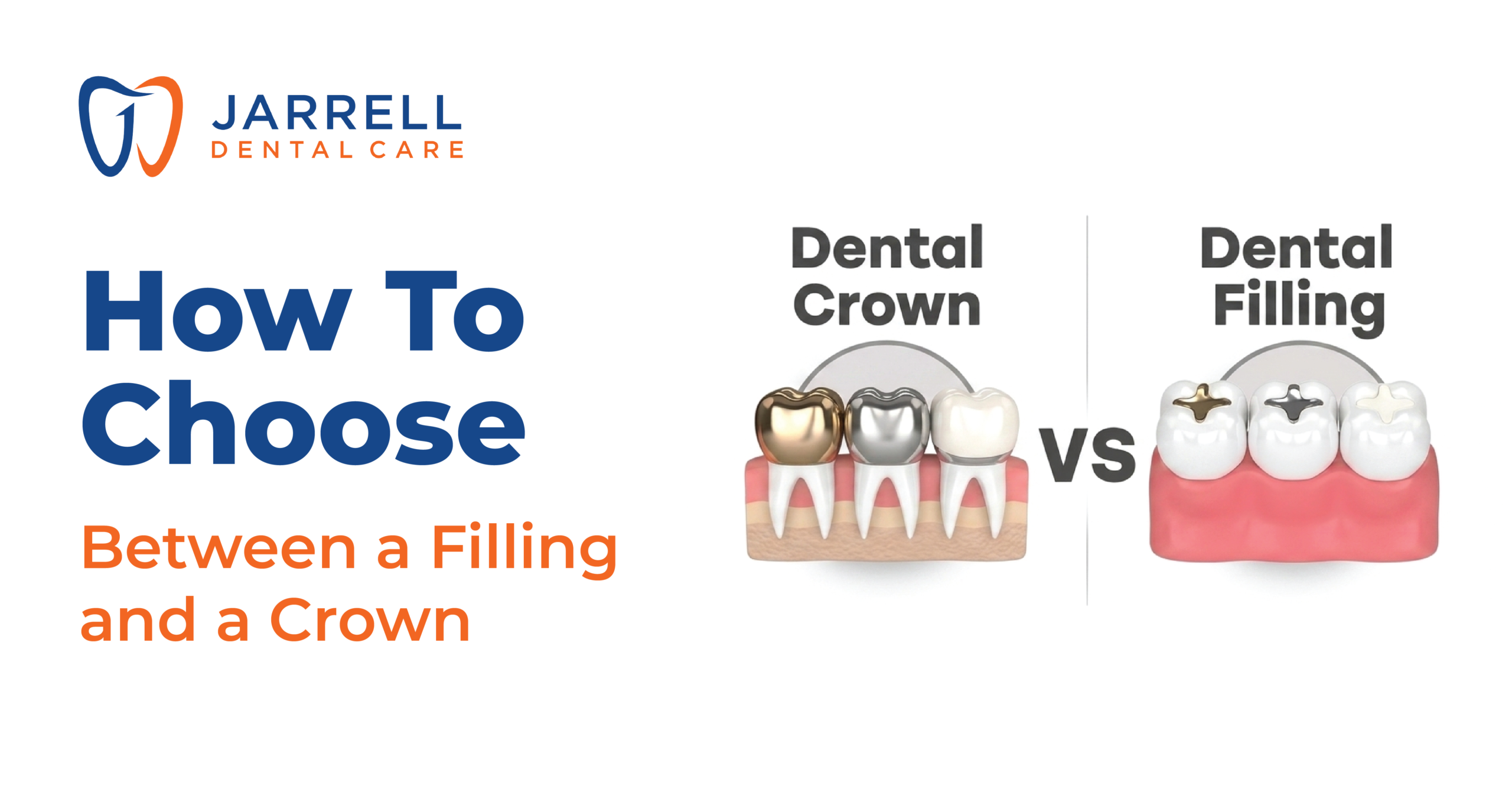 How to Choose Between a Filling and a Crown