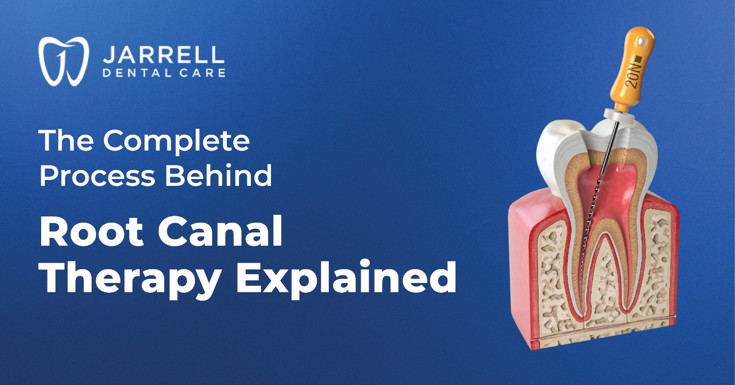 The Complete Process Behind Root Canal Therapy Explained